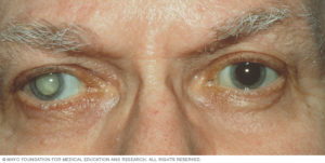 cataract surgery