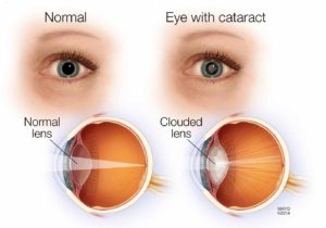 cataract surgery