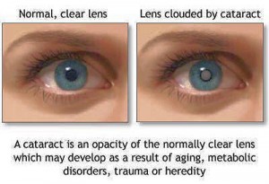 cataract surgery