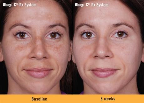 Obagi Before and After 2 | Dr. Lisa Bunin | Allentown PA