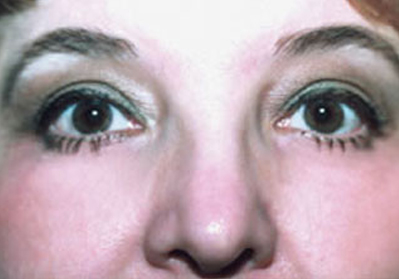 Eyelift Patient After | Blepharoplasty | Bags Under Eyes | Before and After Photos | Dr. Lisa Bunin | Allentown PA