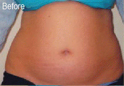 Lipo-Ex on Stomach | Female Patient Before | Before and After Photos | Dr. Lisa Bunin | Allentown PA