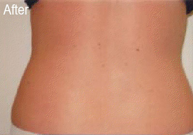 Lipo-Ex on Back | Female Patient After | Before and After Photos | Dr. Lisa Bunin | Allentown PA