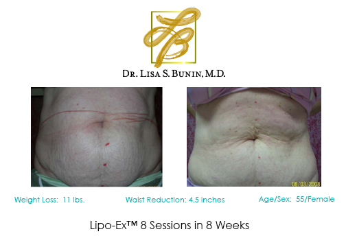 Lipoplasty Patient | Before and After Photos | Dr. Lisa Bunin | Allentown PA