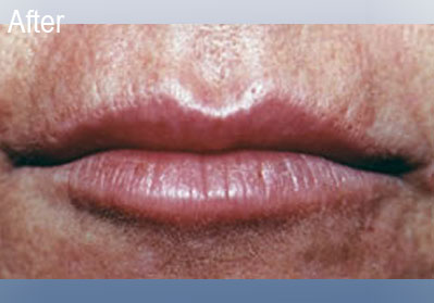 Restylane Lips After 3 | Dr Lisa Bunin | Before and After Photos | Allentown PA