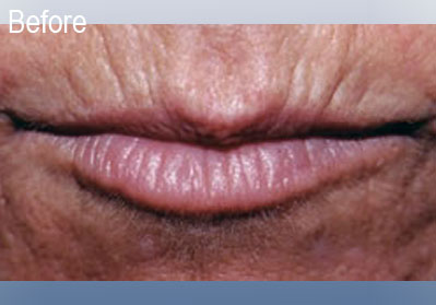 Restylane Lips Before 3 | Dr. Lisa Bunin | Before and After Photos | Allentown PA