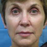 Sculptra Patient 1 After | Front View | Before and After Photos |Dr. Lisa Bunin | Allentown PA
