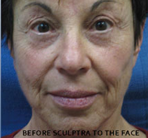 Sculptra Patient 2 Before | Front View | Before and After Photos | Dr. Lisa Bunin | Allentown PA