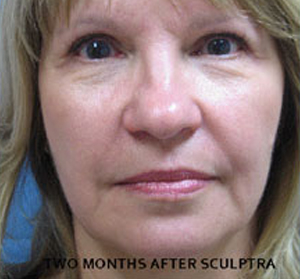 Sculptra Patient 3 After | Front View | Before and After Photos |Dr. Lisa Bunin | Allentown PA