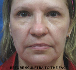 Sculptra Patient 3 Before | Front View | Before and After Photos | Dr. Lisa Bunin | Allentown PA