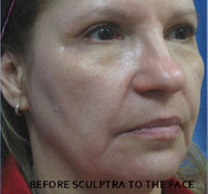 Sculptra Patient 3 Before | Side View | Before and After Photos | Dr. Lisa Bunin | Allentown PA