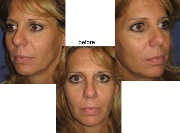 Voluma R-Lift Patient 1 | Dr. Lisa Bunin | Before and After Photos | Allentown PA