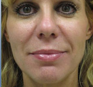 Voluma R Patient 1 After | Front View | Radiesse | Before and After Photos |Dr. Lisa Bunin | Allentown PA