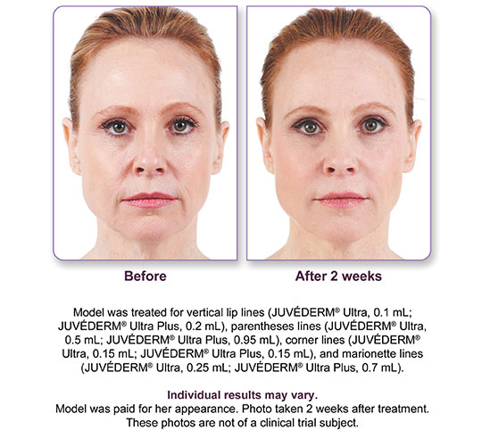 Juvederm Ultra Plus XC Before and After 2 | Dr. Lisa Bunin | Allentown PA