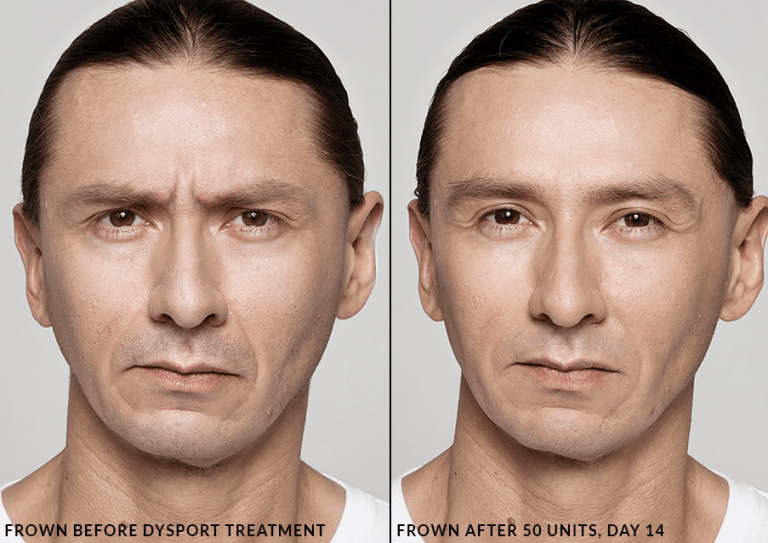 Compare Botox Xeomin And Dysport And You See Similar Results
