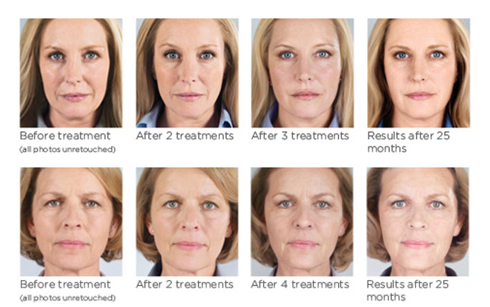Sculptra Before and After 1