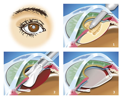 illustration of interocular lens procedure