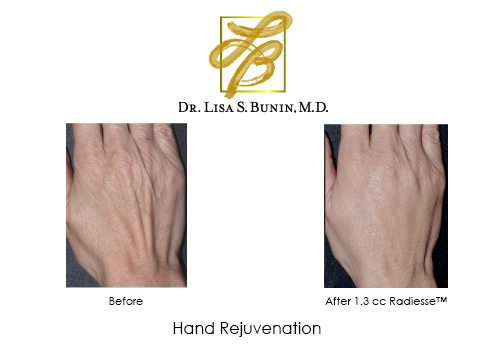 Lisa Bunin Md Hand Rejuvenation Using Radiesse Lisa