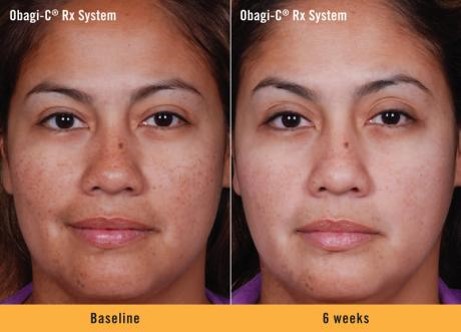 Obagi C Before and After | Dr. Lisa Bunin | Allentown PA