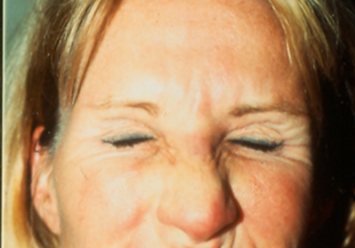 After Frown Botox | Dr Lisa Bunin