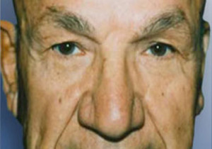 Eyelid Surgery Male Patient After | Blepharoplasty Before and After Photos | Dr. Lisa Bunin | Allentown PA