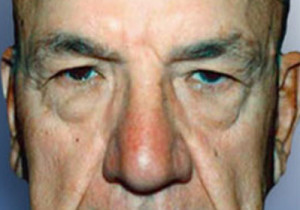 Eyelid Surgery Male Patient Before | Blepharoplasty Before and After Photos | Dr. Lisa Bunin | Allentown PA