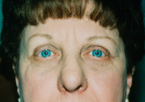 Eyelift Patient After | Blepharoplasty | Before and After Photos | Dr. Lisa Bunin | Allentown PA