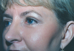 Eyelift Patient After |Blepharoplasty | Before and After Photos | Dr. Lisa Bunin | Allentown PA