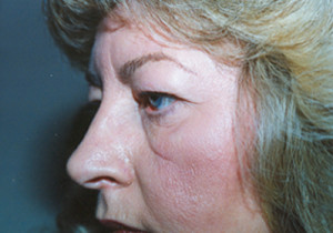 Eyelift Patient Before | Blepharoplasty | Before and After Photos | Dr. Lisa Bunin | Allentown PA