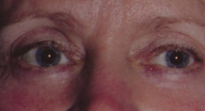Eyelift Patient After | Blepharoplasty | Before and After Photos | Dr. Lisa Bunin | Allentown PA