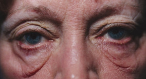 Eyelift Patient Before | Blepharoplasty | Before and After Photos | Dr. Lisa Bunin | Allentown PA