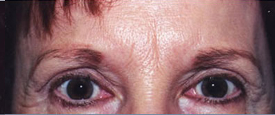 Eyelift Patient After | Blepharoplasty | Before and After Photos | Dr. Lisa Bunin | Allentown PA
