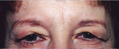 Eyelift Patient Before | Blepharoplasty | Before and After Photos | Dr. Lisa Bunin | Allentown PA