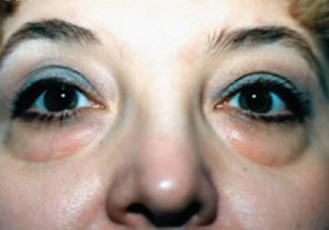 Eyelift Patient Before | Blepharoplasty | Bags Under Eyes | Before and After Photos | Dr. Lisa Bunin | Allentown PA