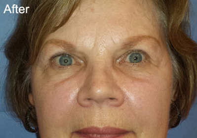 Eyelift Patient After | Blepharoplasty | Before and After Photos | Dr. Lisa Bunin | Allentown PA