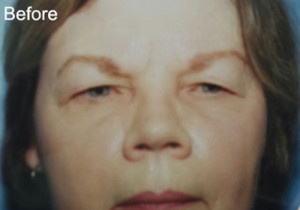 Eyelift Patient Before | Blepharoplasty | Before and After Photos | Dr. Lisa Bunin | Allentown PA