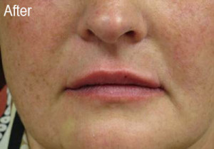 Woman After Filler | Before and After Photos | Dr. Lisa Bunin | Allentown PA