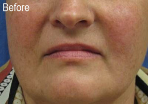 Woman Before Filler | Before and After Photos | Dr. Lisa Bunin | Allentown PA