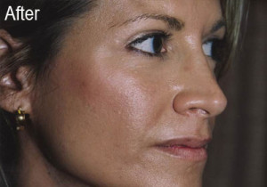 Woman After Filler | Before and After Photos | Dr. Lisa Bunin | Allentown PA