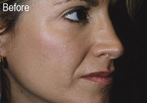 Woman Before Filler | Before and After Photos | Dr. Lisa Bunin | Allentown PA