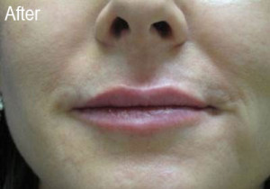 Woman After Filler | Before and After Photos | Dr. Lisa Bunin | Allentown PA