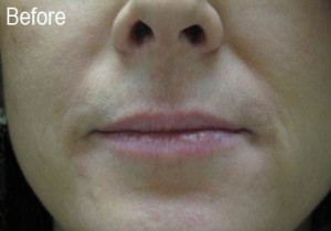 Woman Before Filler | Before and After Photos | Dr. Lisa Bunin | Allentown PA