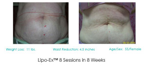 Lipo-Ex Stomach Before and After Patient | Fat Loss | Dr. Lisa Bunin | Allentown PA