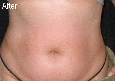 Lipo-E on Stomach | Female Patient After | Before and After Photos | Dr. Lisa Bunin | Allentown PA