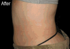 Lipo-Ex on Stomach | Female Patient After | Before and After Photos | Dr. Lisa Bunin | Allentown PA