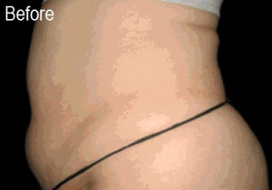 Lipo-Ex on Stomach | Female Patient Before | Before and After Photos | Dr. Lisa Bunin | Allentown PA