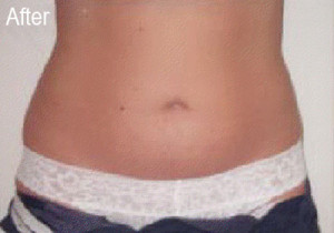 Lipo-Ex on Stomach | Female Patient After | Before and After Photos | Dr. Lisa Bunin | Allentown PA