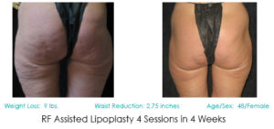 Lipoplasty Patient | Before and After Photos | Dr. Lisa Bunin | Allentown PA