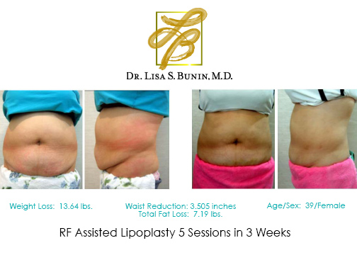 Lipoplasty Patient | Before and After Photos | Dr. Lisa Bunin | Allentown PA