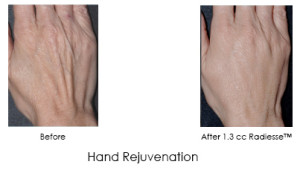 Hand Rejuvenation with Radiesse | Before and After Photos | Dr. Lisa Bunin | Allentown PA
